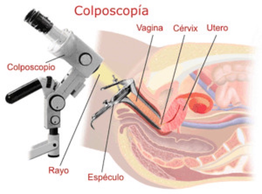 Colposcopia