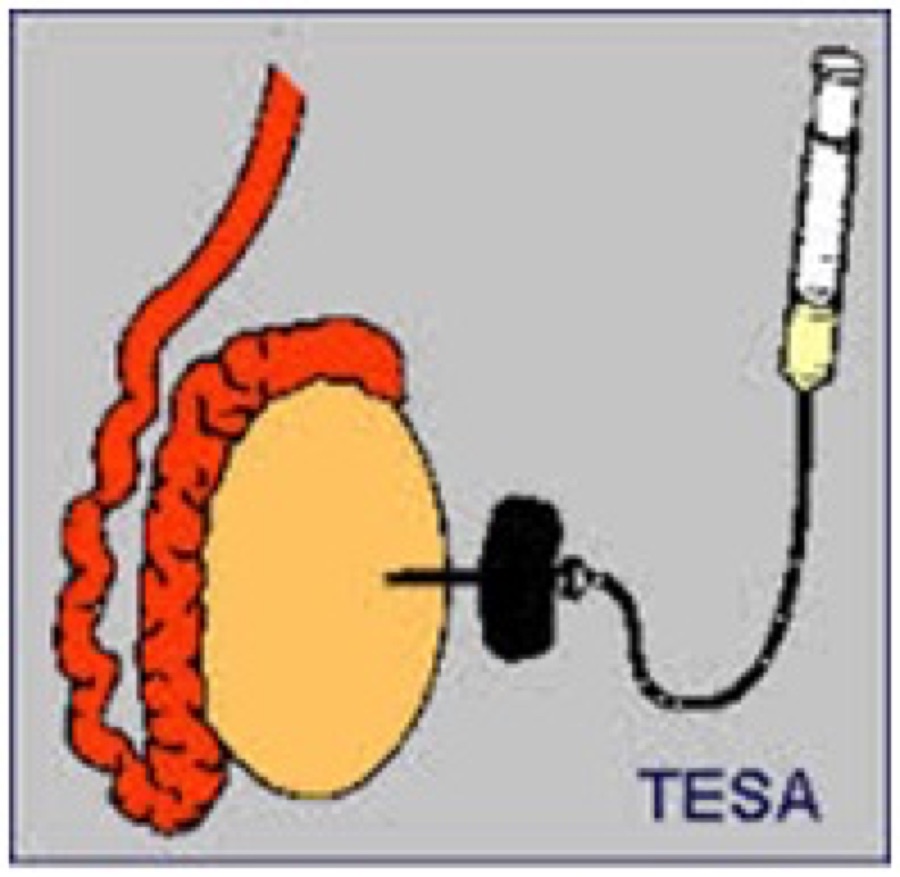 ICSI-TESA — Aspirazione testicolare