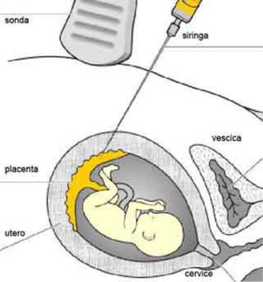 Amniocentesi e villocentesi